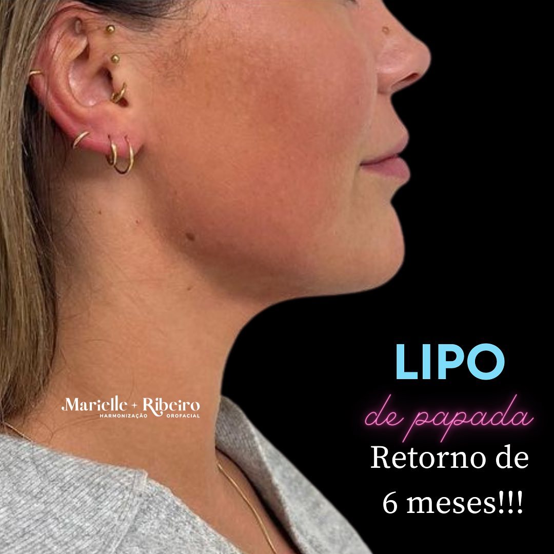 Dra. Marielle Ribeiro Lipo de Papada #3.2